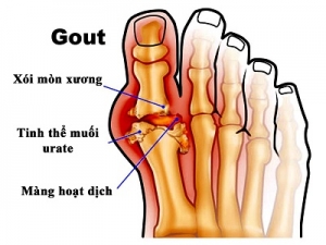 Chuẩn đoán và điều trị bệnh gout